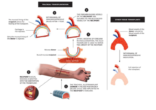 India's first 'tracheal transplant' surgery is a success ! - DailyRounds