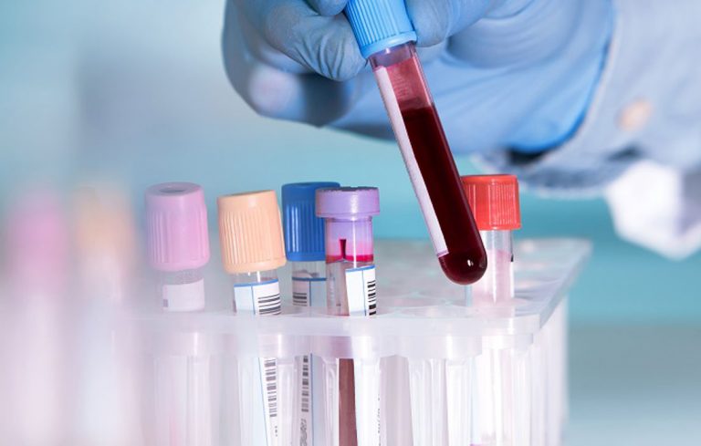 developing-a-blood-test-for-prostate-cancer-regenerative-medical-group