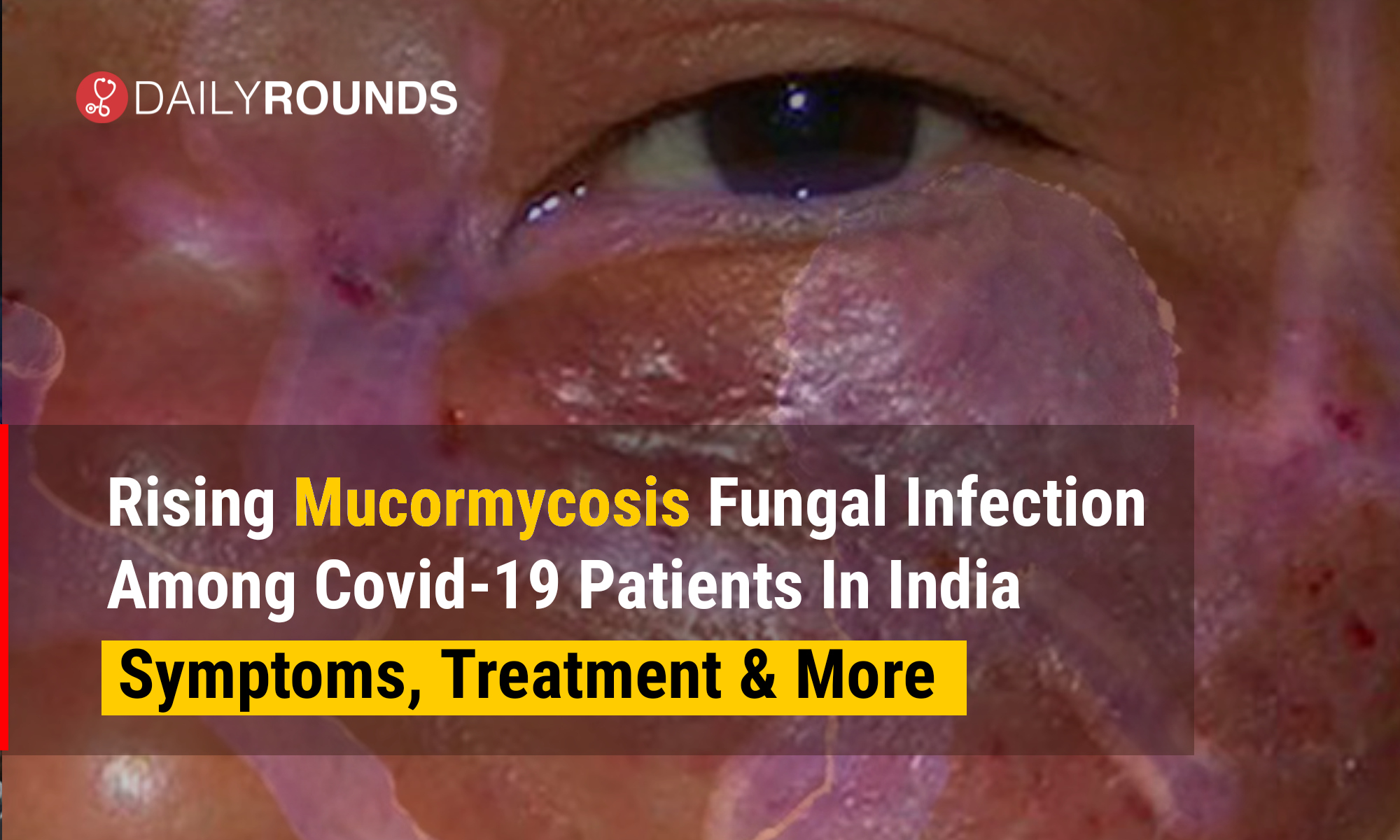 rising-mucormycosis-fungal-infection-among-covid-19-patients-in-india